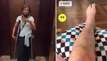 Luciana Gimenez mostra hematomas na perna um mês após acidente grave de esqui