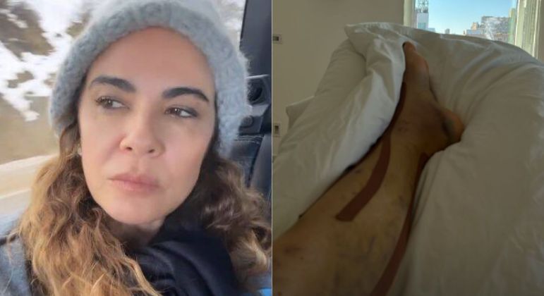 Luciana Gimenez mostra perna machucada