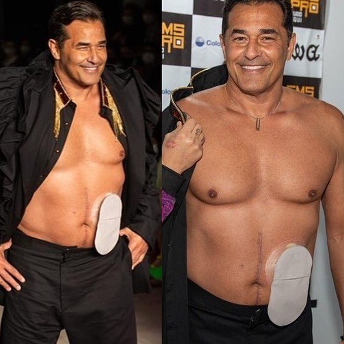 Luciano Szafir desfilou com bolsa de estomia à mostra