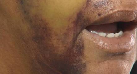 Vítima ficou com ferimentos no rosto