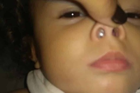 mãe alerta nariz filha