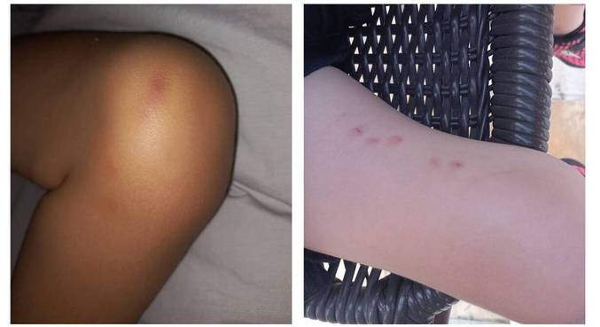 Menina chegou da escola com vários hematomas e marcas de unha nas pernas
