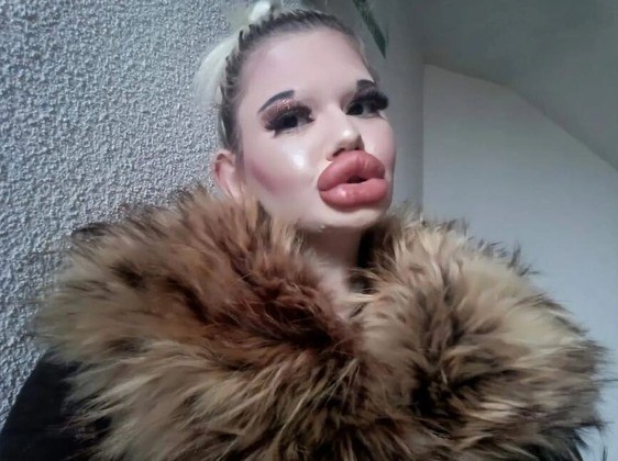 Você já conhece Andrea Ivanova, a búlgara com lábios gigantescos que não cansa de fazer novas cirurgias. Eis que ela apresentou ao mundo uma nova meta: ter as maiores maçãs do rosto de todos os tempos