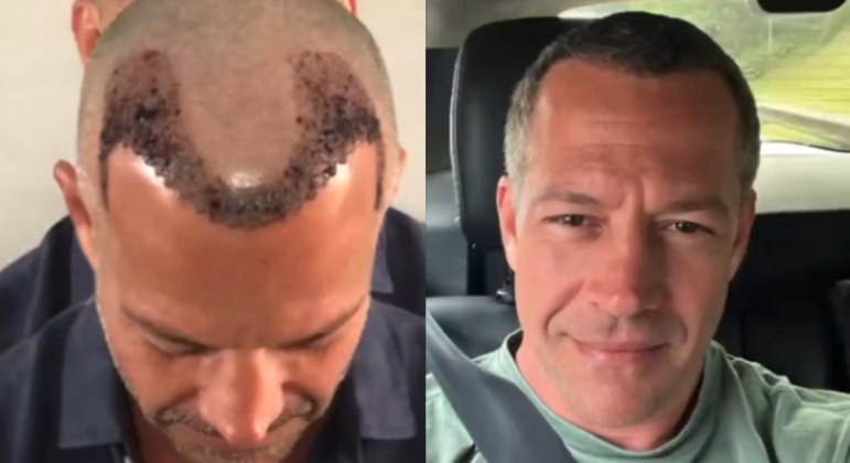Antes e depois do cabelo de Malvino  