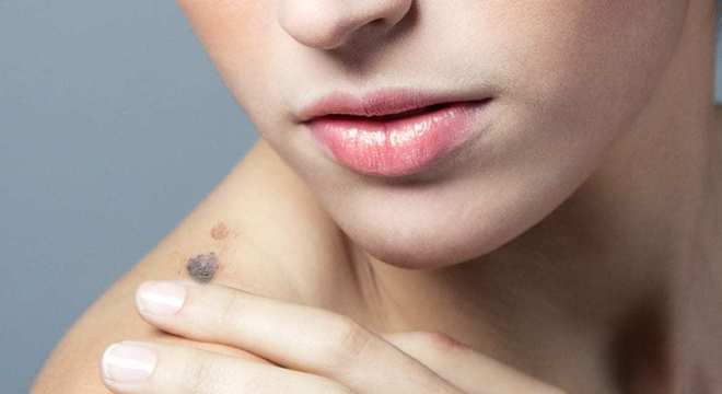 Manchas escuras na pele: O que , tipos e tratamentos