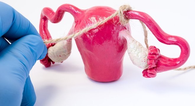 A laqueadura é um metódo anticoncepcional praticamente irreversível