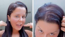 Calvície feminina: veja cuidados que combatem a queda de cabelo
