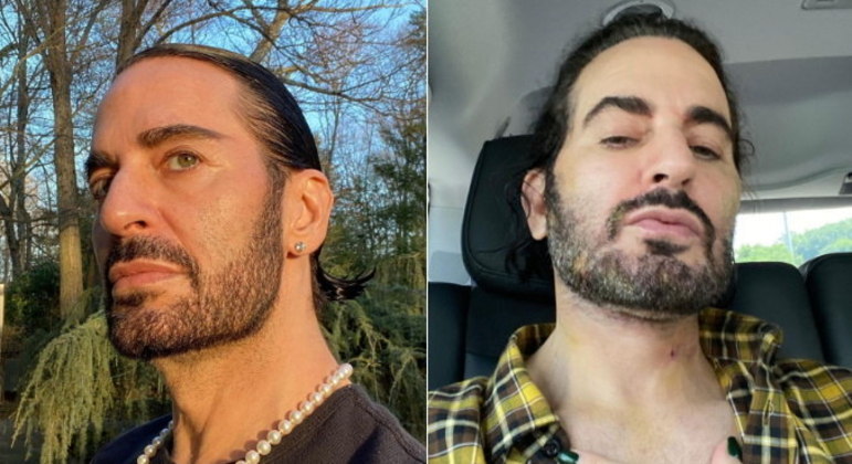 Marc JacobsO estilista Marc Jacobs não só fala de seus procedimentos estéticos, como mostra sem problemas o 