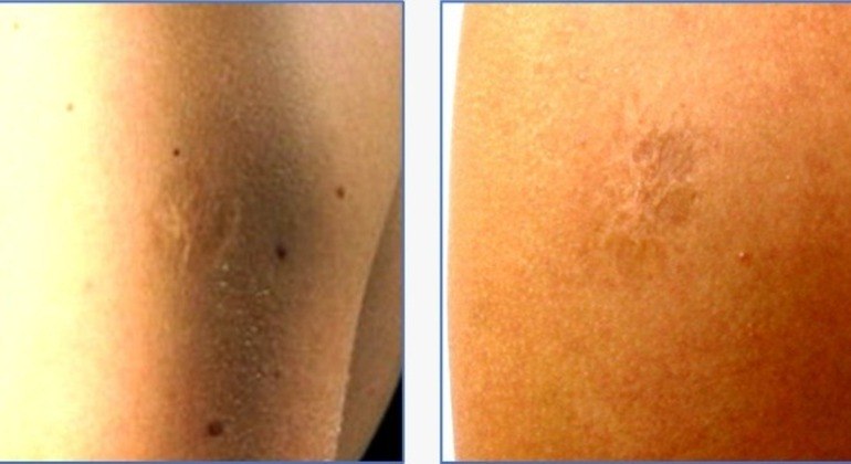 Cicatriz deixada pela vacina de varíola normalmente fica no braço esquerdo