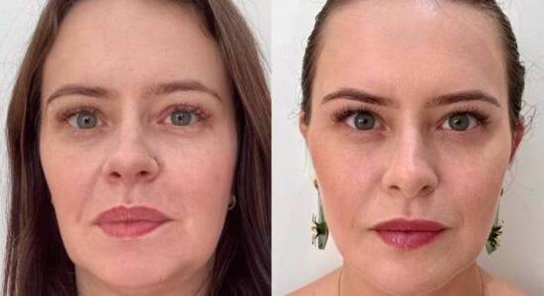 Mari Bridi faz harmonização facial para tirar aparência 'caída' do rosto