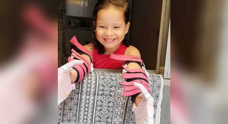 Maria Beattriz, de 4 anos, perdeu as mãos devido a uma infecção generalizada 