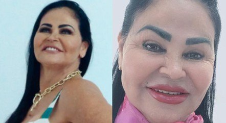 Maria Costa antes e depois de fazer harmonização facial