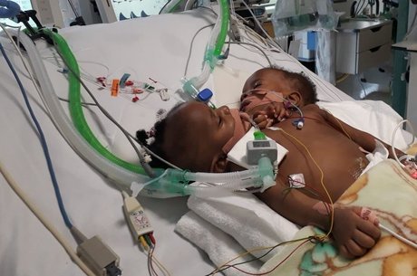 Exames não haviam detectado que crianças eram siamesas