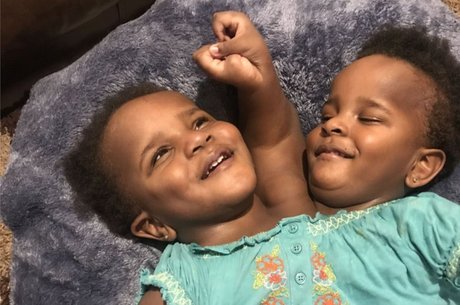 Ibrahima só descobriu que era pai de gêmeas siamesas após o parto