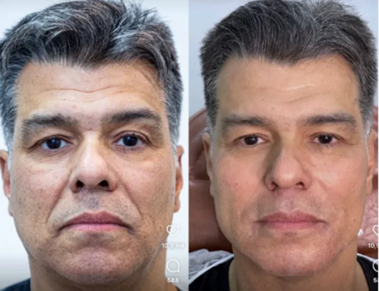 Aos 58 anos, Maurício Mattar fez harmonização facial, o primeiro procedimento estético, também em julho. 