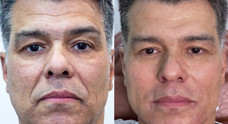 Maurício Mattar antes e depois de fazer harmonização facial