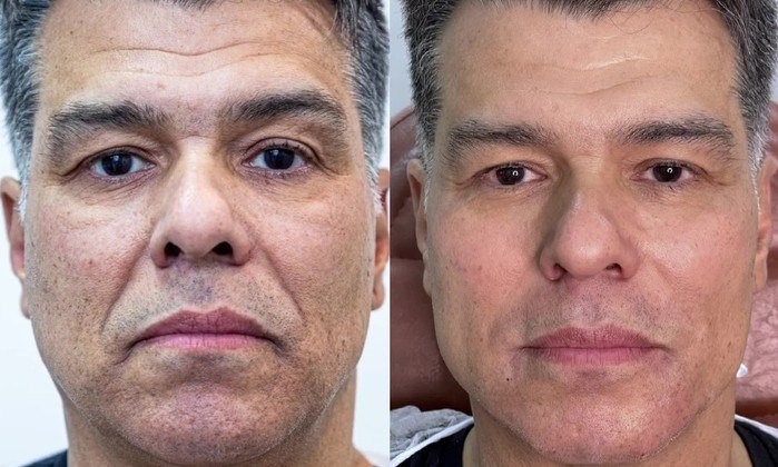 Maurício MattarO ator, de 58 anos, fez harmonização facial pela primeira vez em julho deste ano. Segundo informações divulgadas pela clínica na qual ele foi atendido, Maurício nunca tinha passado por nenhum procedimento estético. A ideia do ator era que o resultado ficasse bastante natural