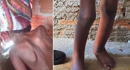 Criança estava desnutrida e machucada