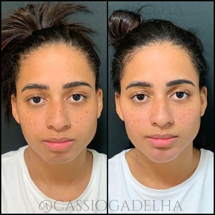 MC Loma também dividiu opiniões após ter passado pelo procedimento, em 2019. Na época a cantora compartilhou em seu Instagram o resultado da primeira etapa do processo, que chamou de 'projeto Kardashian' — em referência à família de Kim Kardashian. Entretanto, alguns de seus seguidores não viram nenhuma diferença no rosto da cantora