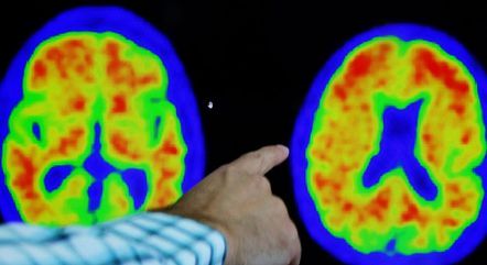 Médico aponta traço de mal de Alzheimer durante exame em hospital de Boston, nos Estados Unidos