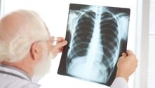 Mais de 3,5 milhões podem ter fibrose pulmonar pós-covid 