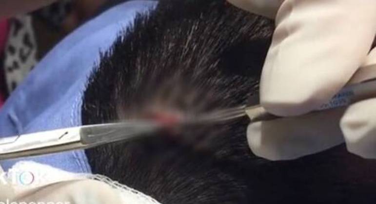O procedimento simples contou com uma pequena incisão no couro cabeludo do paciente
