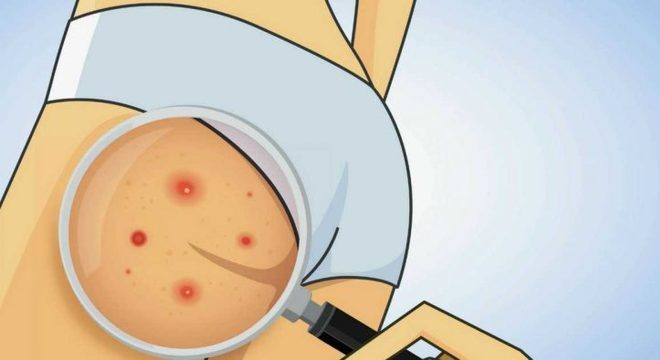 Melhores remédios caseiros para foliculite