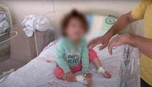 Menina de dois anos mata cobra com mordidas após levar picada no lábio