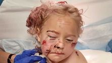 Menina de 5 anos leva 50 pontos no rosto após ataque de cão