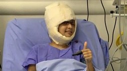 Jovem escalpelada em acidente de kart faz enxerto de pele no couro cabeludo (Divulgação)