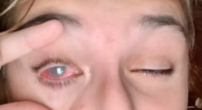 Olivia Stegin ficou cega de um olho após acidente com tubo de tinta