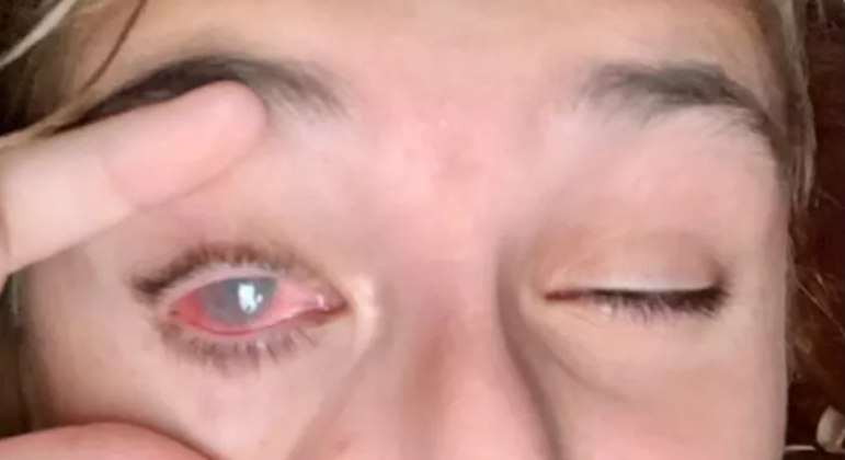 Olivia Stegin ficou cega de um olho após acidente com tubo de tinta