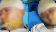 Menina sofre traumatismo craniano após ser agredida com régua de metal por professor