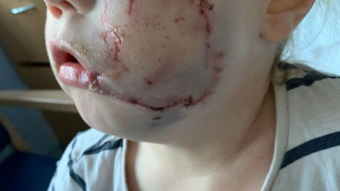 Four-year-old girl gets 40 stitches in her face after being attacked by a mad dog – news