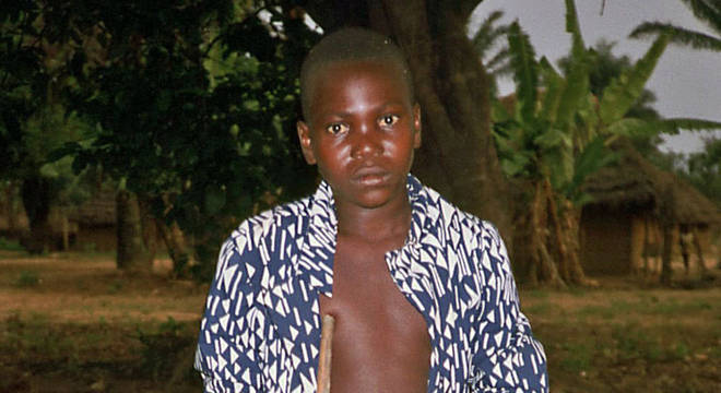 Menino com konzo, fotografado no Zaire (atual República Democrática do Congo) em setembro de 1986