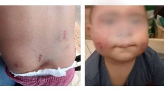 MG: menino de 2 anos fica com hematomas no corpo ao ser mordido por colega em creche