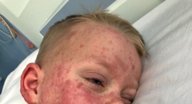 Menino precisou ser internado por causa de sua doença rara e do paracetamol