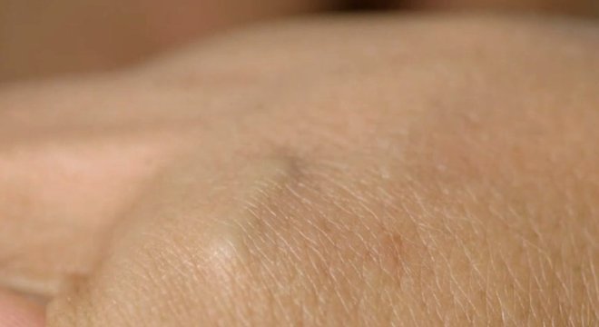 O microchip é implantado debaixo da pele, entre o polegar e o indicador