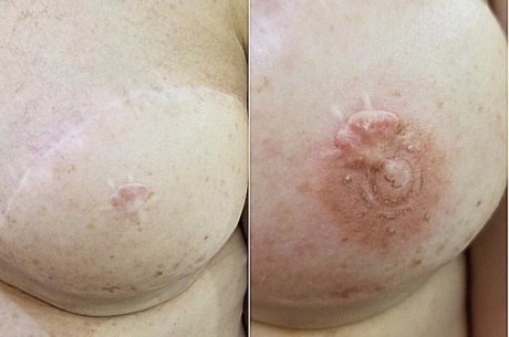 Processo reconstrói aréolas de mulheres mastectomizadas