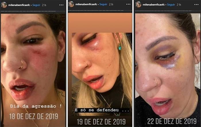 Como ficou o rosto da ex-esposa, depois da agressão de Jean. Sem perdão no Morumbi