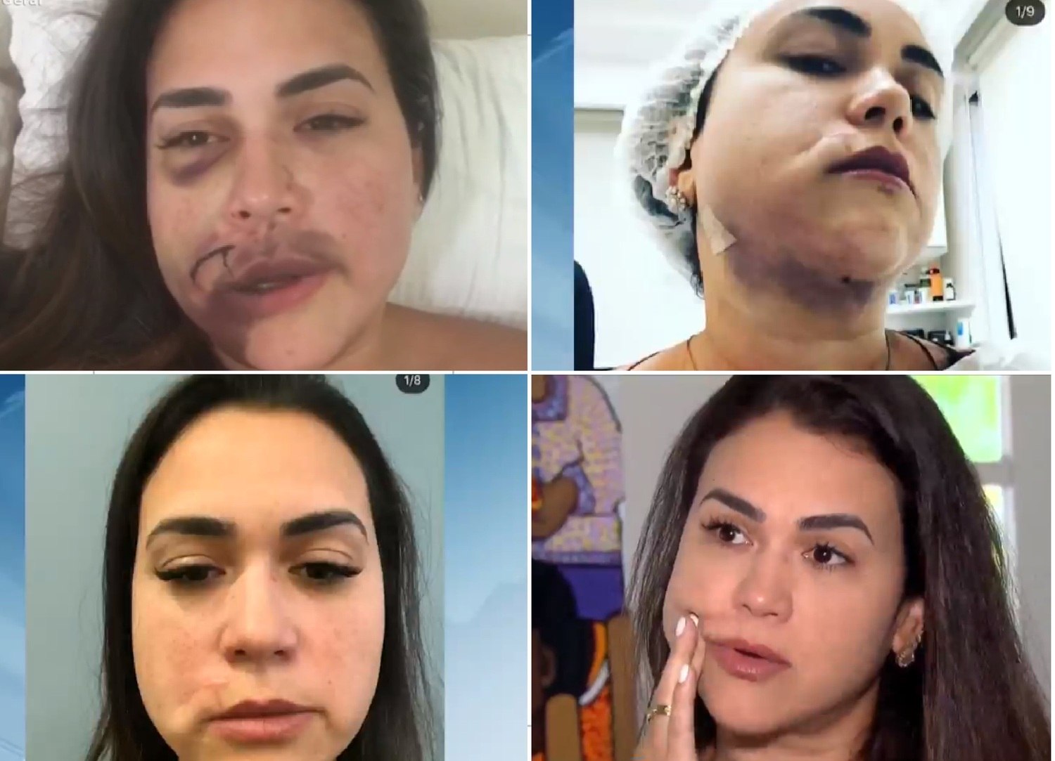 Milka Borges mostra evolução do tratamento após a agressão 