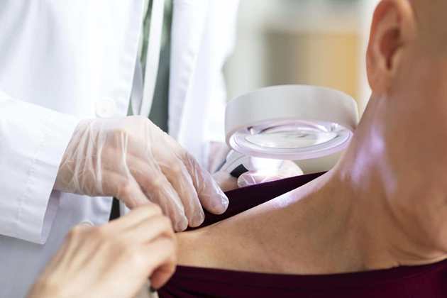 O mês de dezembro é marcado pela prevenção ao câncer mais incidente no Brasil, o de pele. O tipo mais frequente no país é o carcinoma basocelular, considerado pouco agressivo, seguido do carcinoma espinocelular (não tão agressivo, mas que pode evoluir para metástase) e o melanoma - se origina nas pintas e é o mais perigoso.Para ter um tratamento curativo e mais simples em qualquer um dos casos, o indivíduo deve estar atento aos primeiros sinais da doença. No caso dos carcinomas basocelular e espinocelular, há lesões avermelhadas e elevadas que parecem verrugas e espinhas, mas não coçam e doem. O melanoma, por sua vez, deixa a pinta com formato irregular e com múltiplas cores, e pode coçar, machucar e sangrar. Estar atento a esses sinais é essencial, mas as pessoas também devem conhecer o que é mito ou verdade sobre a doença