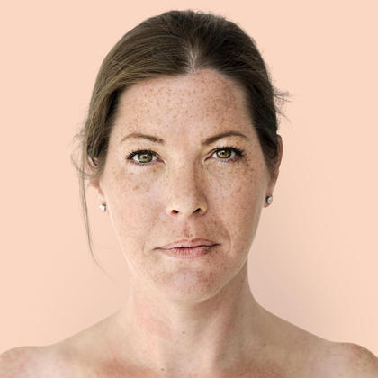 Melasma pode virar câncer? MITOO melasma é uma condição que desencadeia um maior acúmulo de melanina na pele, o que leva à aparição de manchas. No entanto, essas manchas não se transformam em câncer de pele.