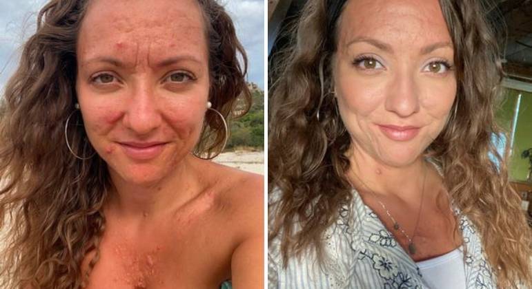 Mandy Nazé demorou anos para conseguir controlar a doença de pele