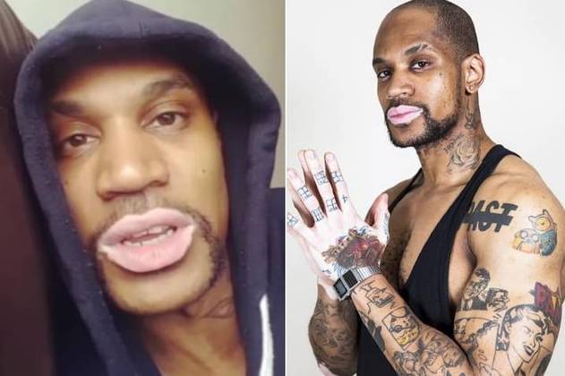 Darius Vernon encarou altas doses de bullying por conta do vitiligo, doença autoimune que tira a coloração natural da pele. Felizmente ele se recuperou da depressão que esteve atrelada a sua condição dermatológica e além de modelo, também é autor e músicoÉ esse também o caso do modelo brasileiro Roger Monte, que relatou o drama que viveu até aceitar doença: 