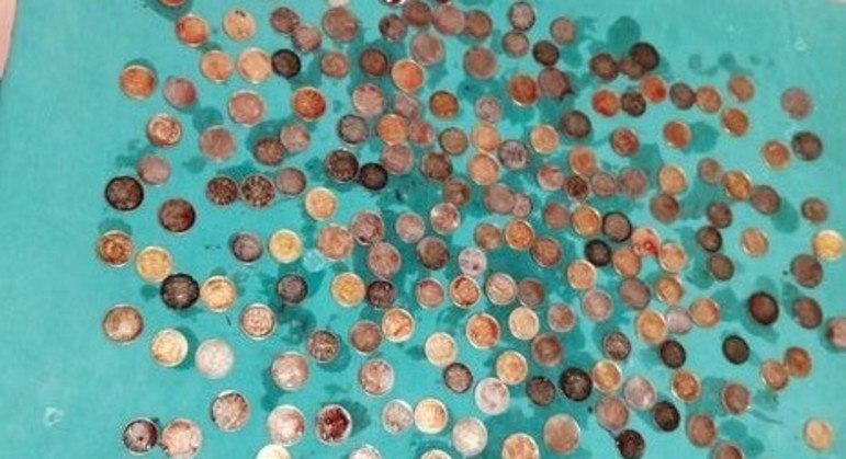 O homem só parou de comer moedas quando o estômago ficou totalmente cheio