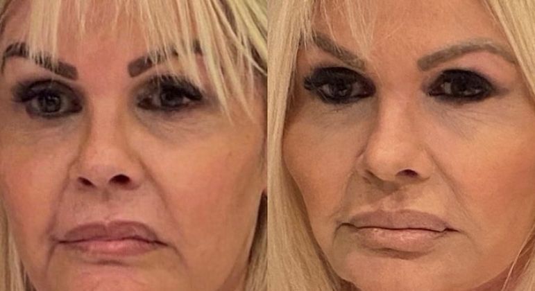 Monique Evans mostra antes e depois de aplicação de fios de sustentação