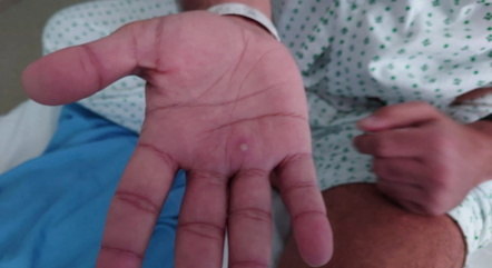 Pessoa diagnosticada com a varíola do macaco
