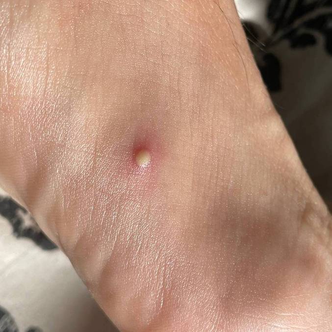 El número de casos de viruela del simio en Brasil crece un 61% en una semana y llega a 1721 casos