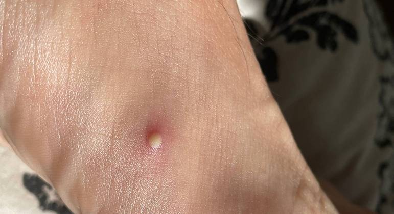 Brasil registrou 3.000 casos em 16 de agosto